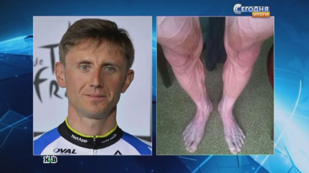 Нога велосипедиста после. Ноги велогонщика после тур де Франс.