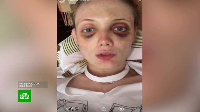 Сергей Харитонов показал разбитое лицо после нападения Яндиева — фото