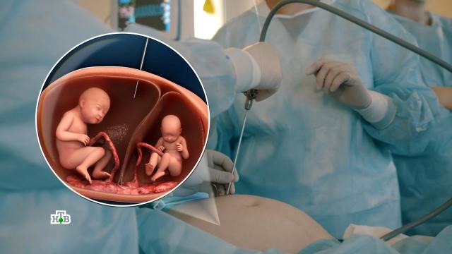 Хирургия в зародыше: как делают фетальные операции.НТВ.Ru: новости, видео, программы телеканала НТВ