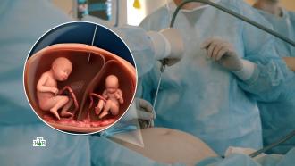 Хирургия в зародыше: как делают фетальные операции