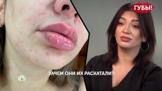 Бесплатная операция по увеличению губ изуродовала жительницу Челябинска